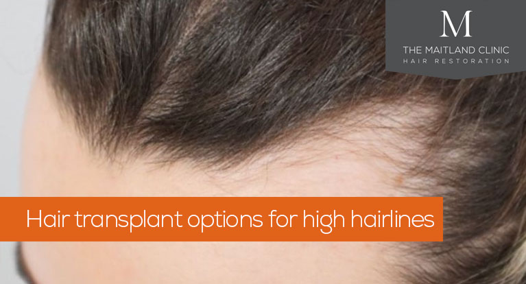 Hair transplant options for high hairlines