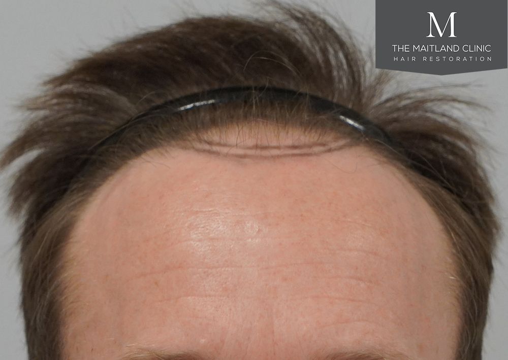 991 grafts by FUE