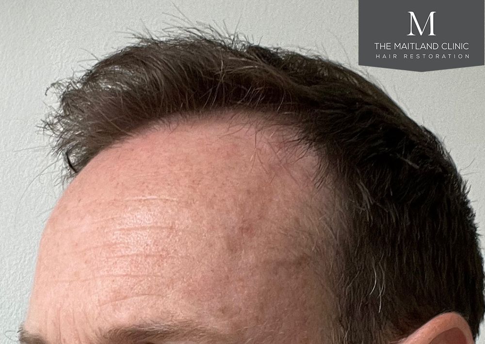 991 grafts by FUE