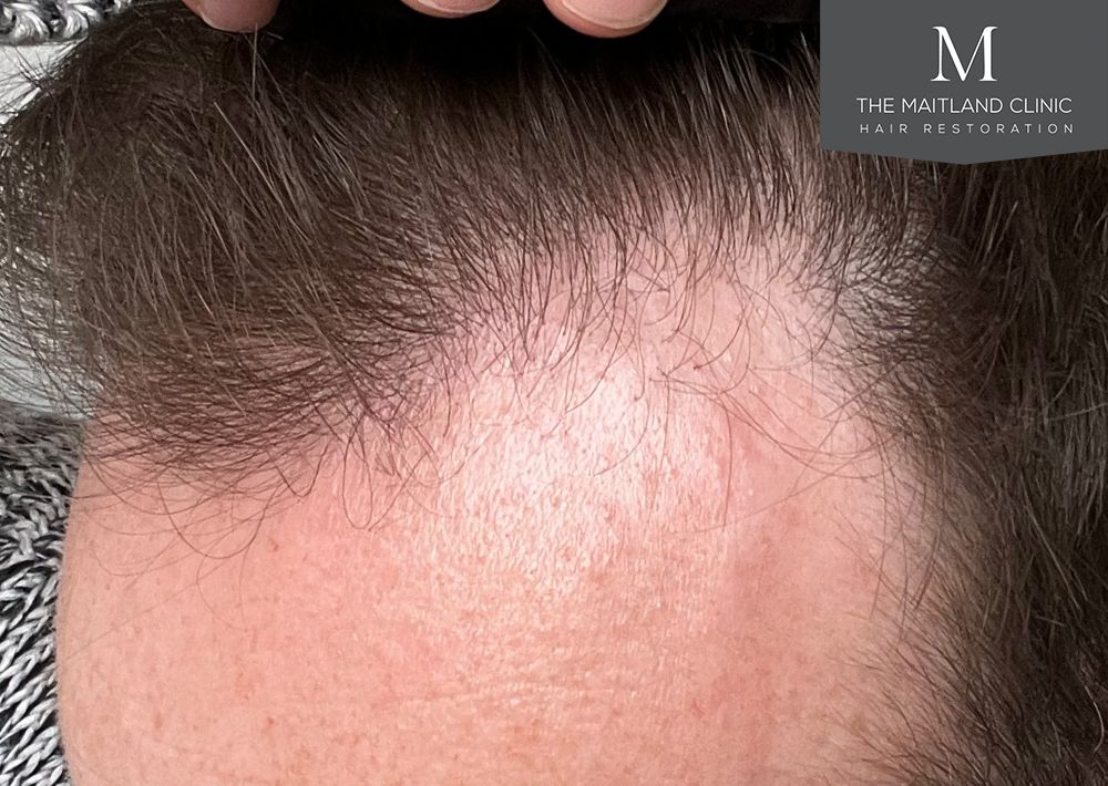 991 grafts by FUE