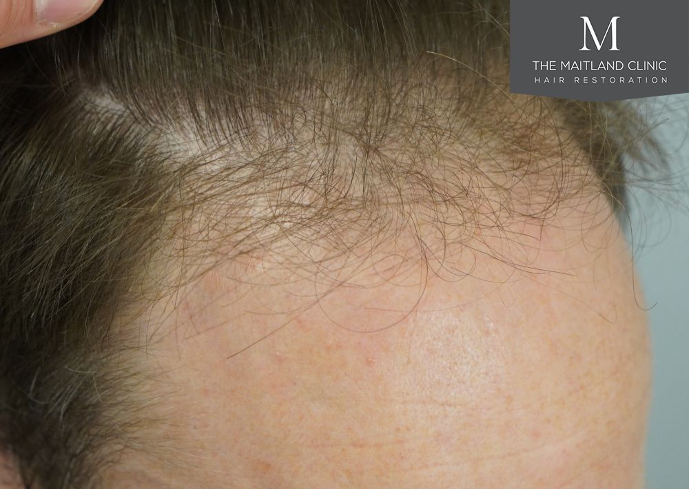 991 grafts by FUE