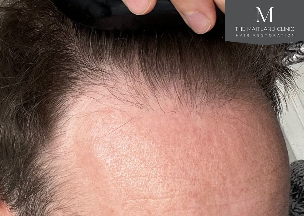 991 grafts by FUE