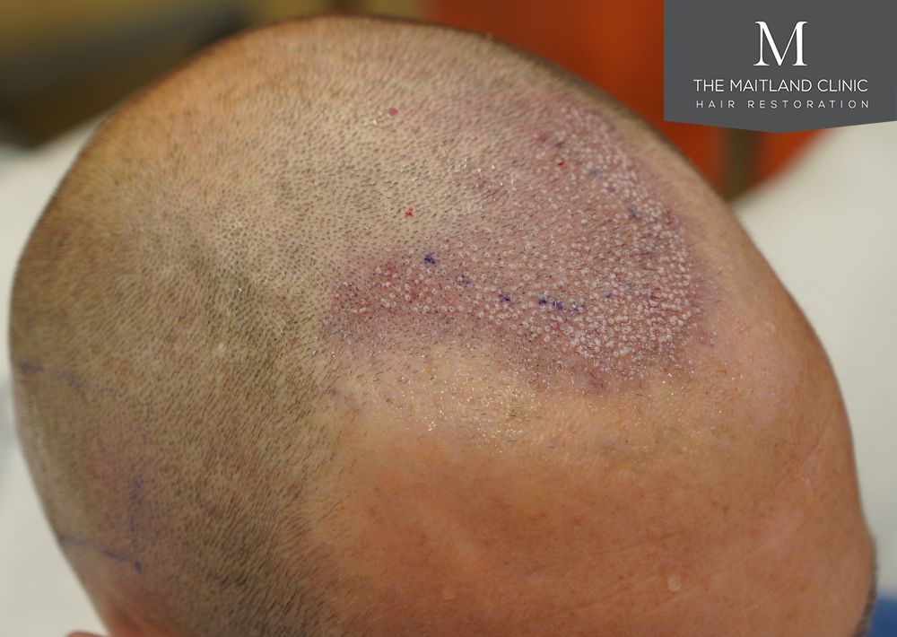 991 grafts by FUE