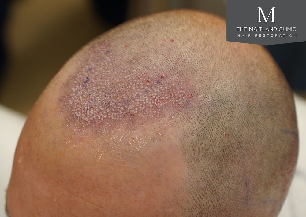 991 grafts by FUE