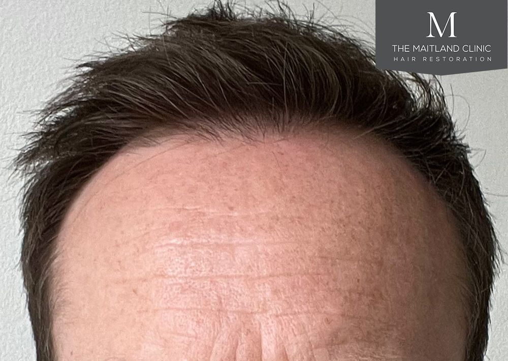 991 grafts by FUE