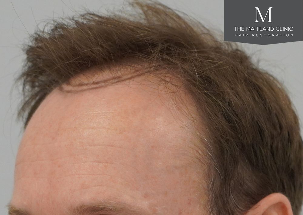 991 grafts by FUE