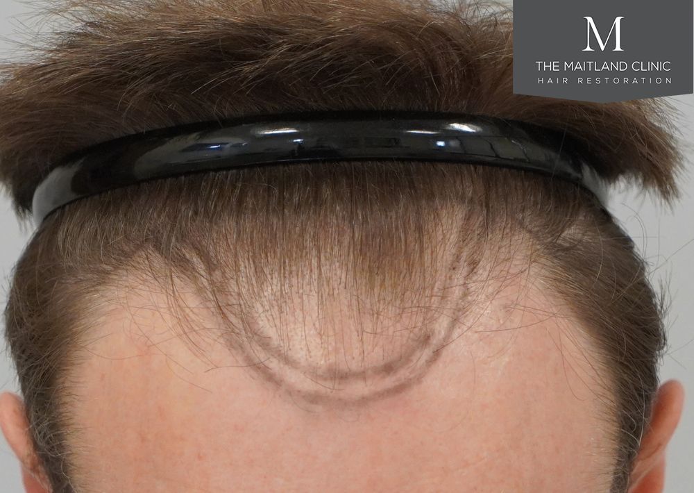 991 grafts by FUE