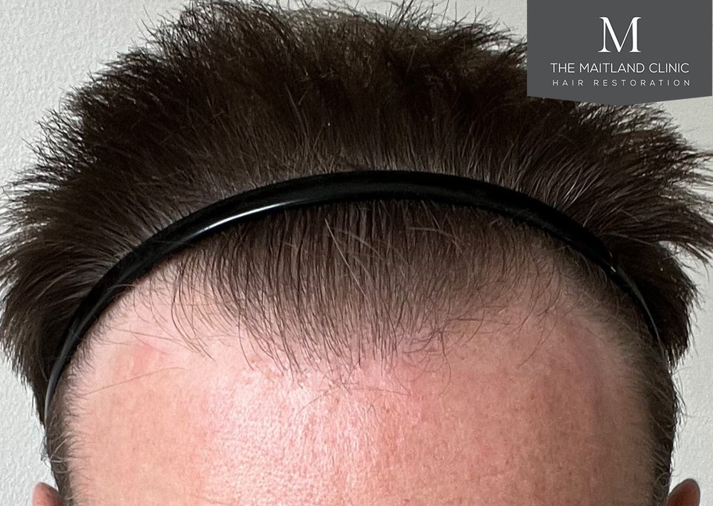 991 grafts by FUE