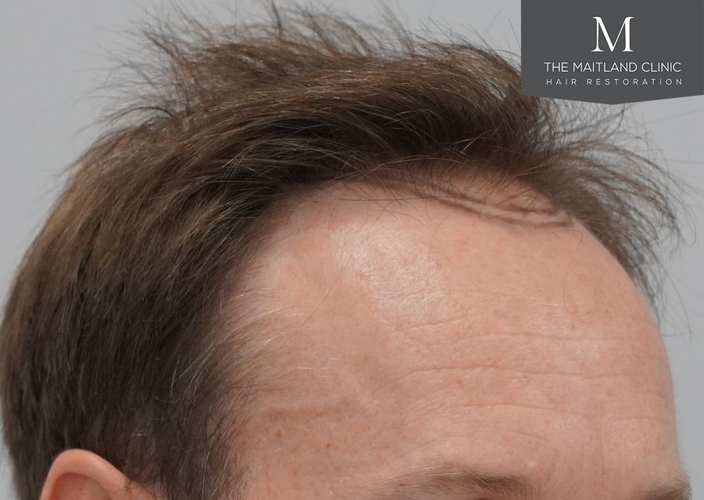 991 grafts by FUE