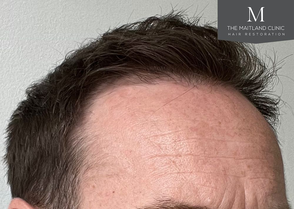 991 grafts by FUE
