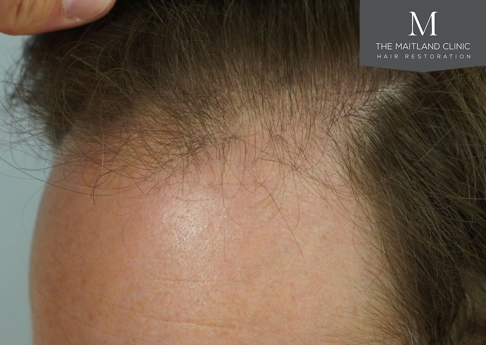 991 grafts by FUE