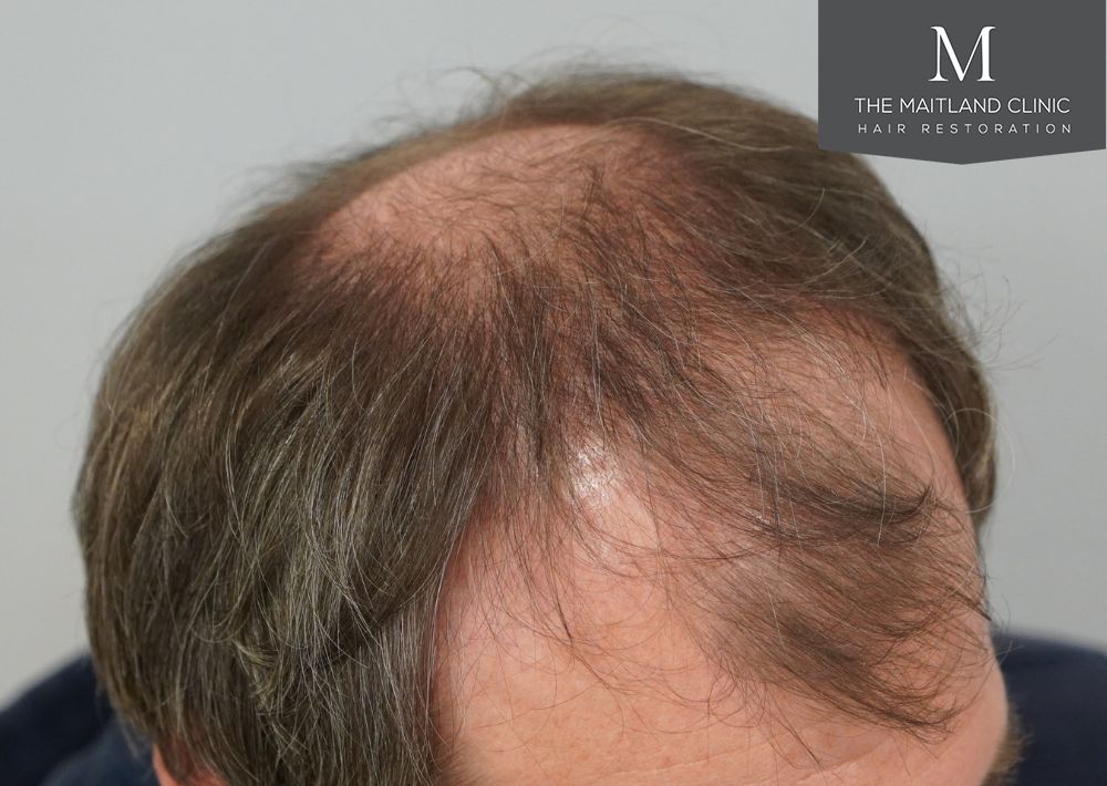 3535 grafts by FUT