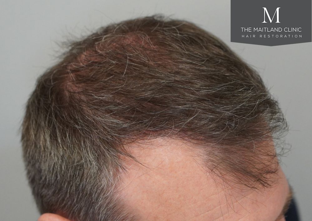 3535 grafts by FUT