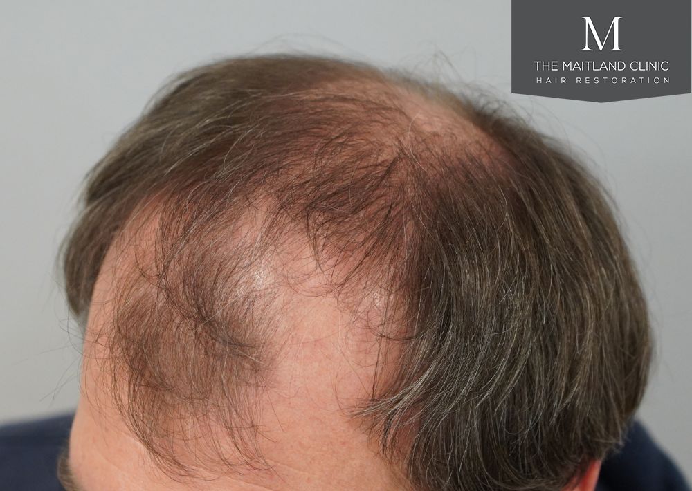 3535 grafts by FUT