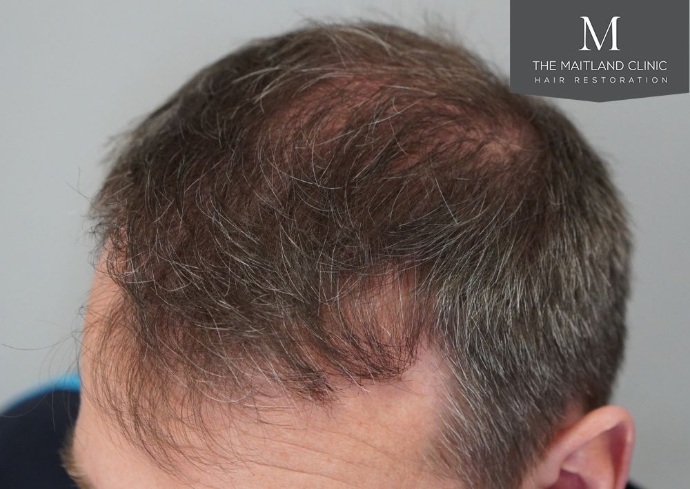 3535 grafts by FUT