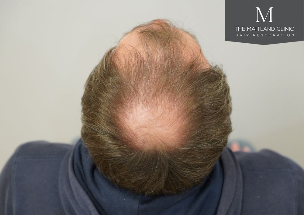 3535 grafts by FUT