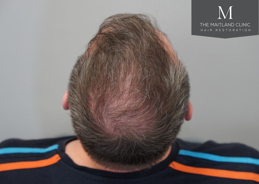 3535 grafts by FUT