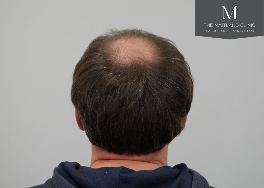 3535 grafts by FUT