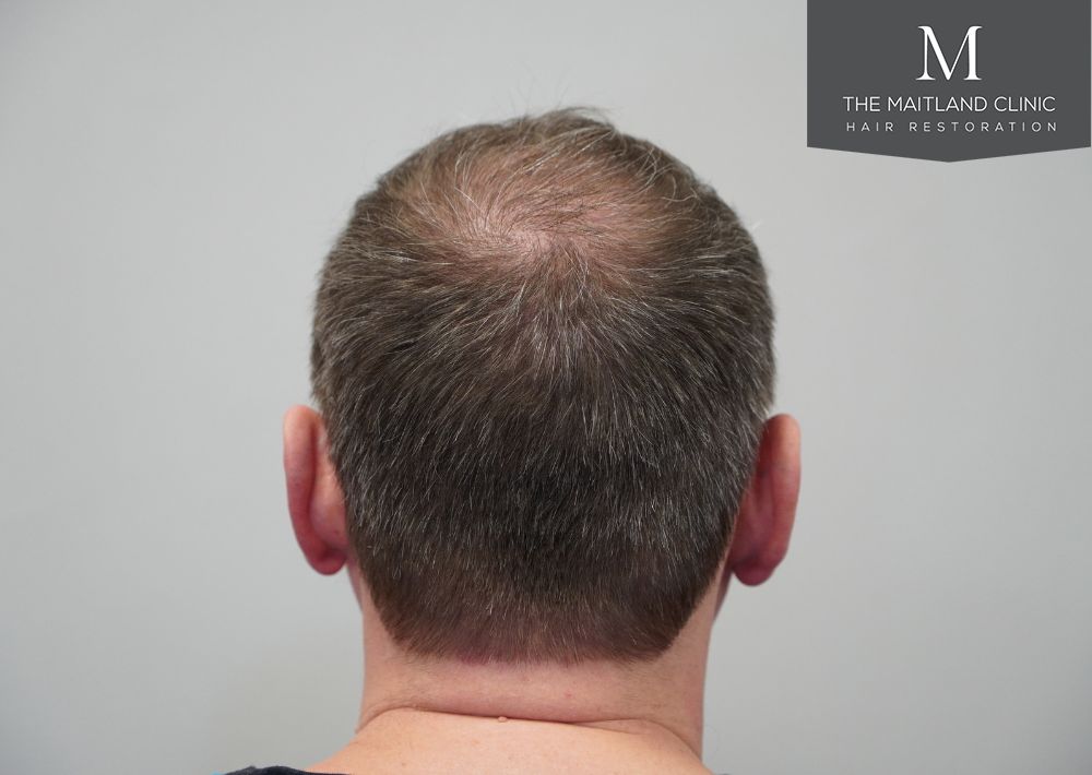 3535 grafts by FUT