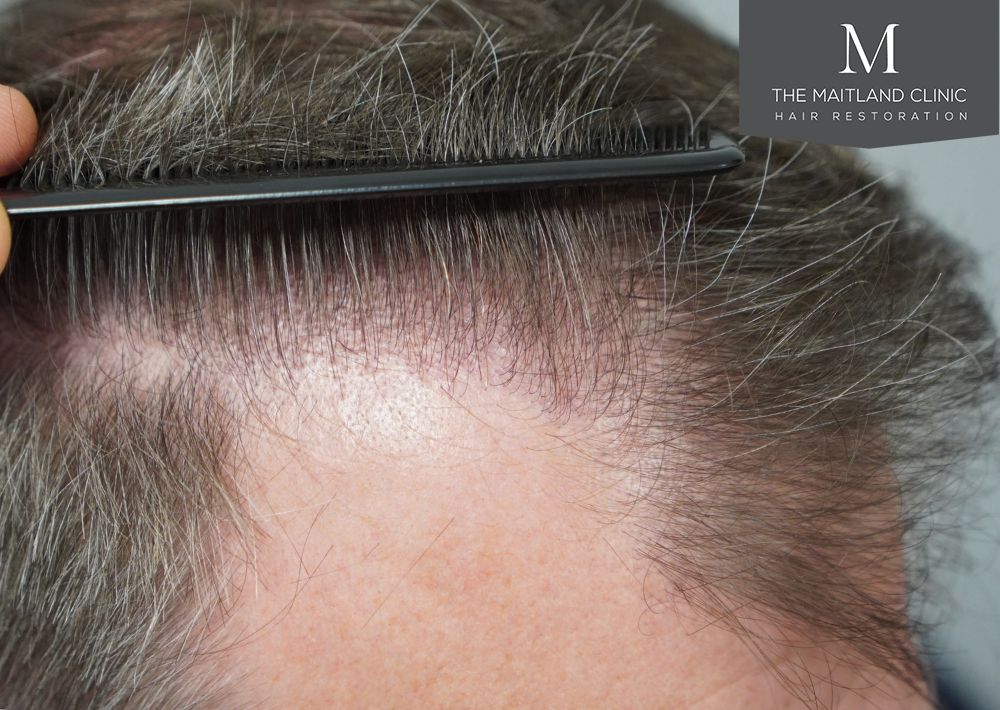 3535 grafts by FUT