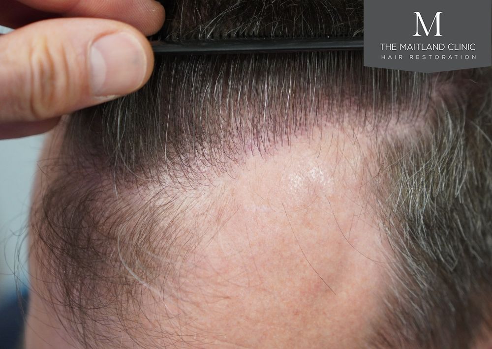 3535 grafts by FUT
