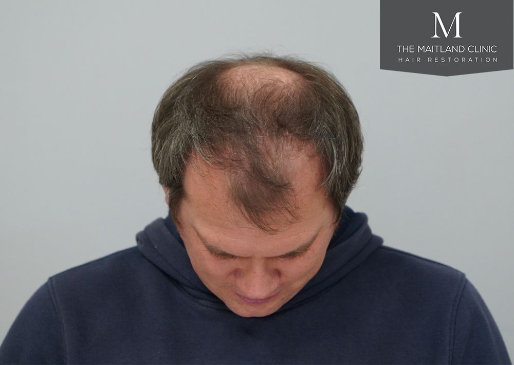 3535 grafts by FUT