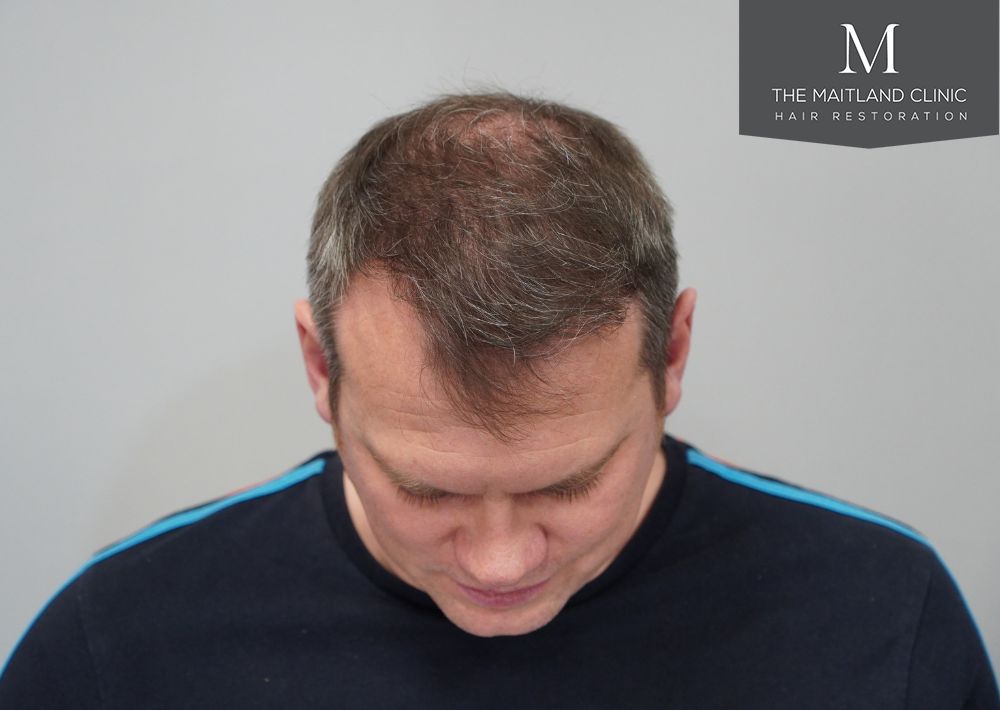 3535 grafts by FUT