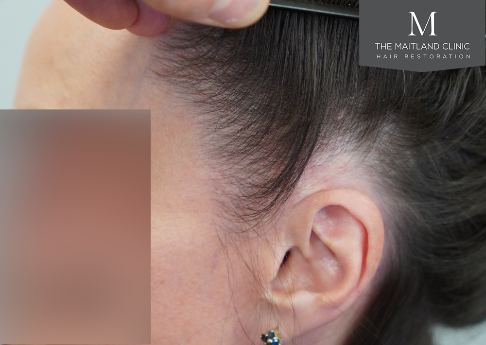607 grafts by FUE