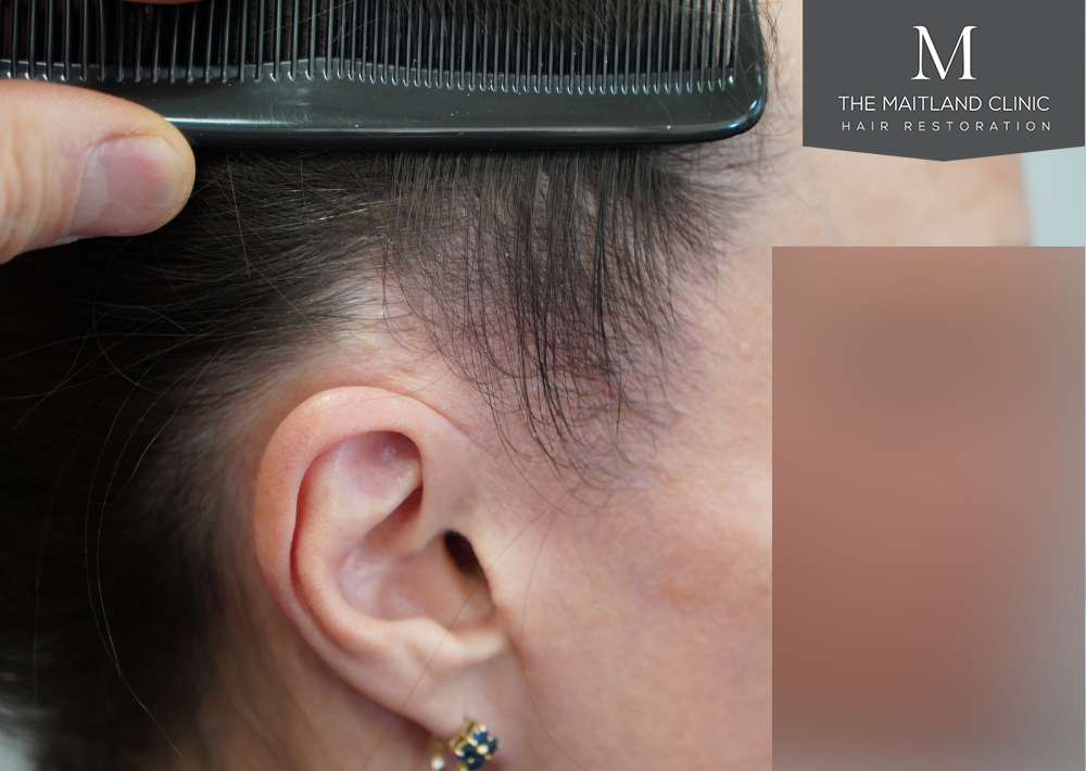 607 grafts by FUE