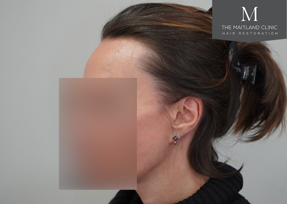 607 grafts by FUE