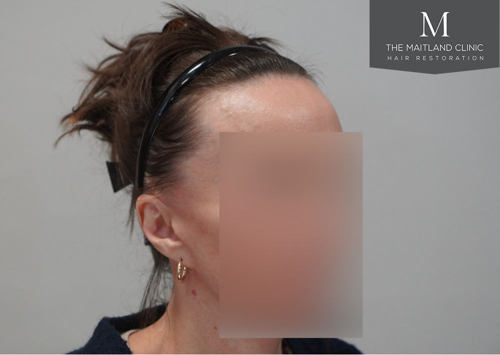 607 grafts by FUE