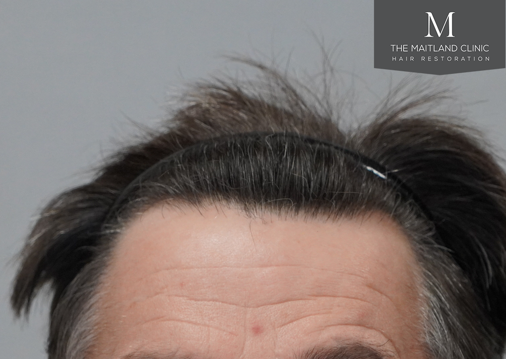 1357 grafts by FUE