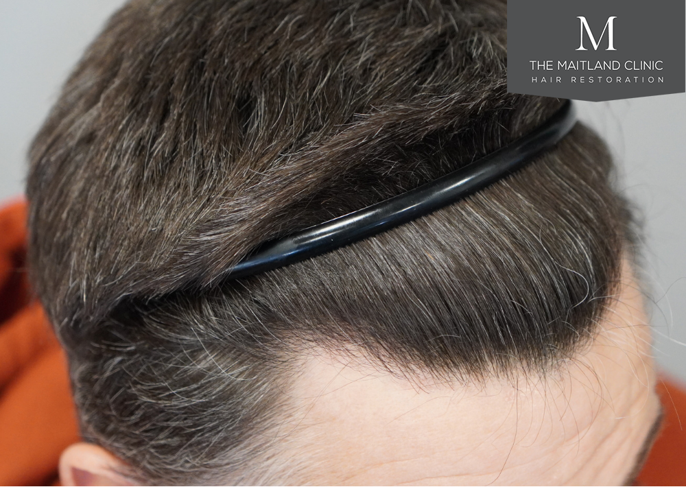 1357 grafts by FUE