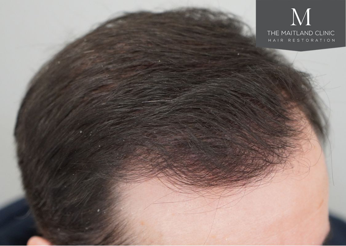 3803 grafts by FUT