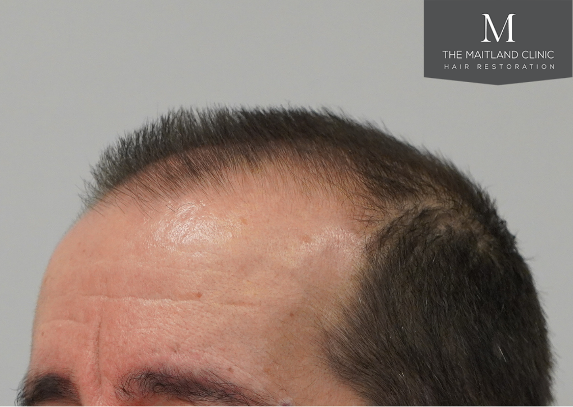 3803 grafts by FUT
