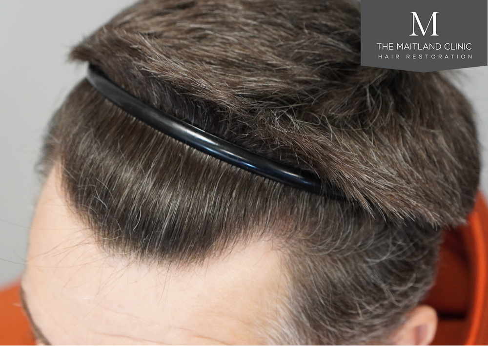 1357 grafts by FUE