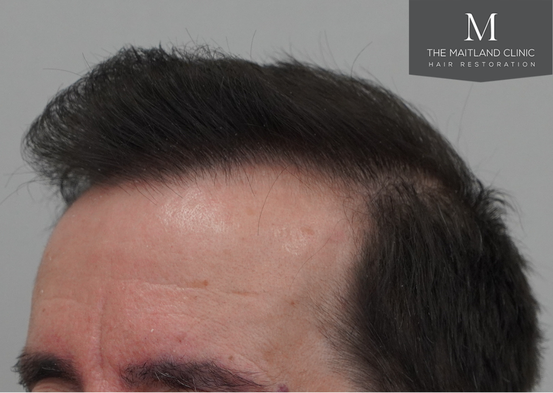 3803 grafts by FUT