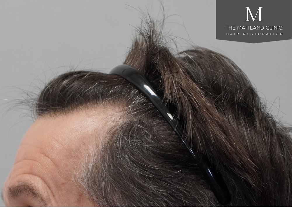 1357 grafts by FUE