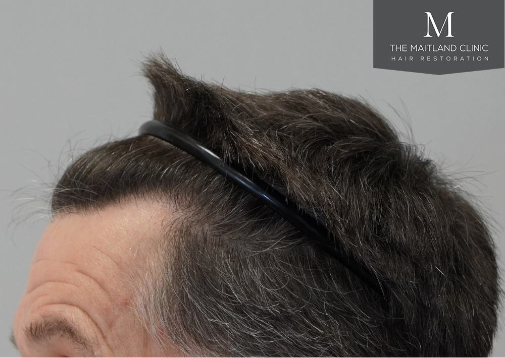 1357 grafts by FUE