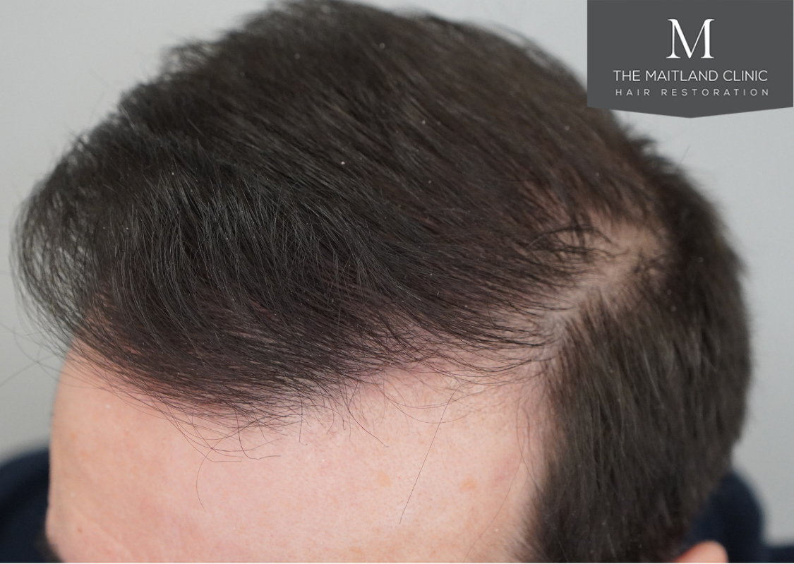 3803 grafts by FUT