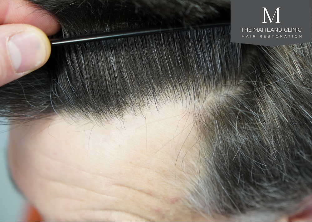 1357 grafts by FUE
