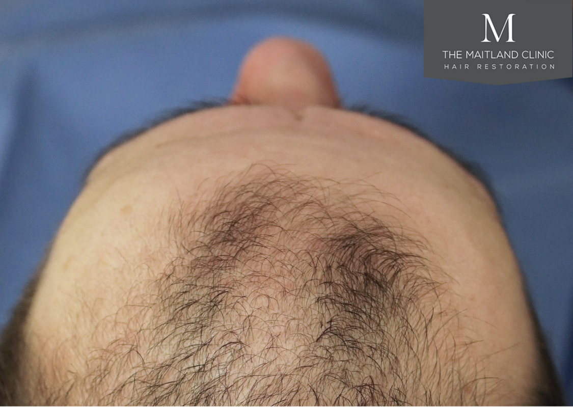 3803 grafts by FUT