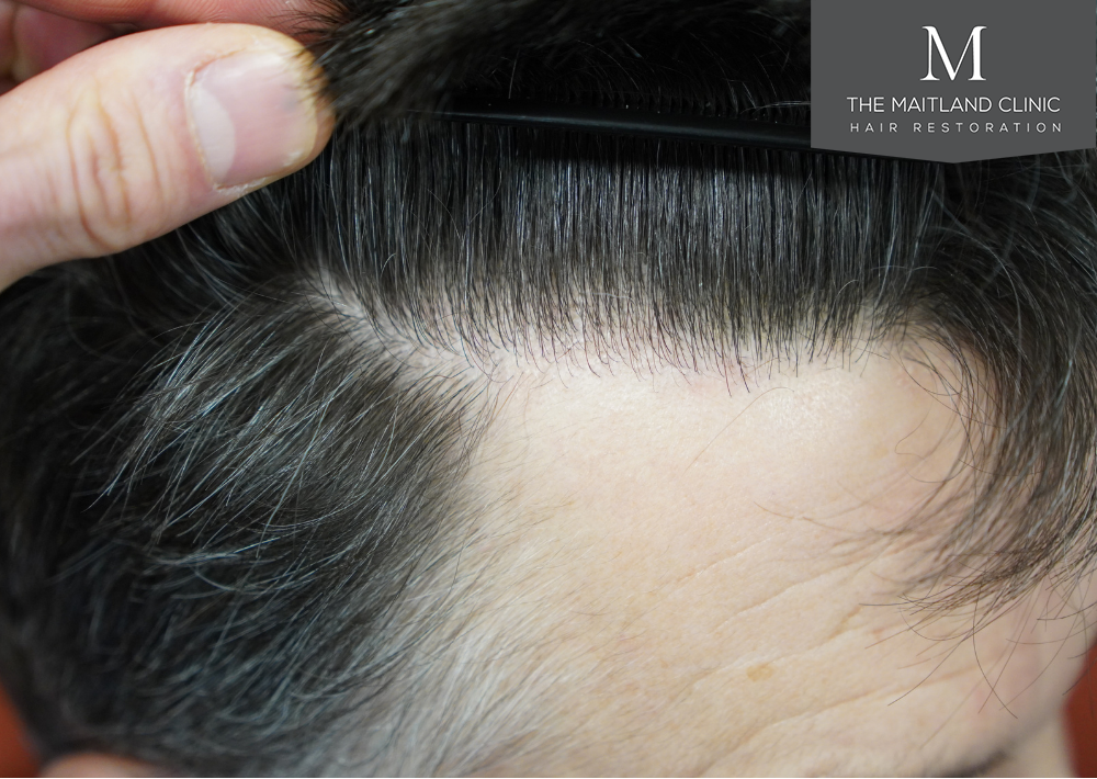 1357 grafts by FUE