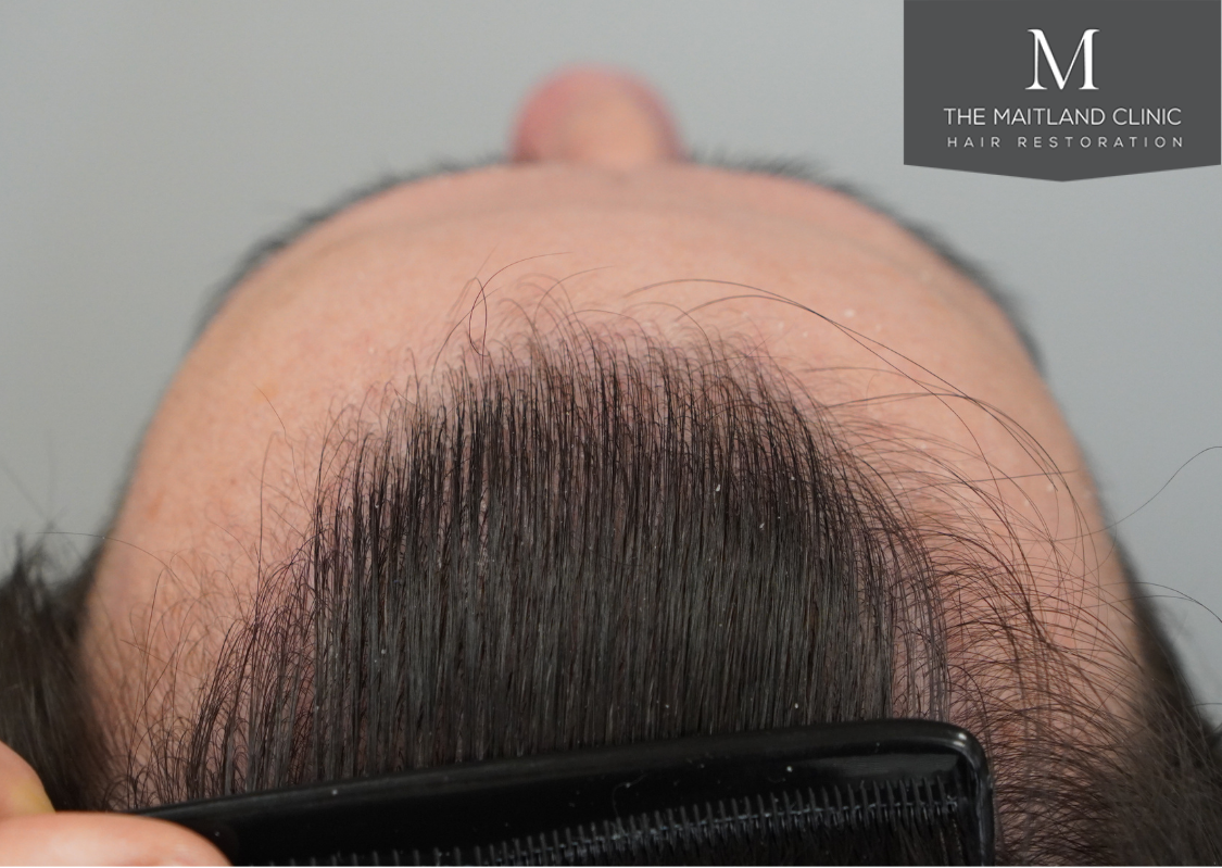 3803 grafts by FUT