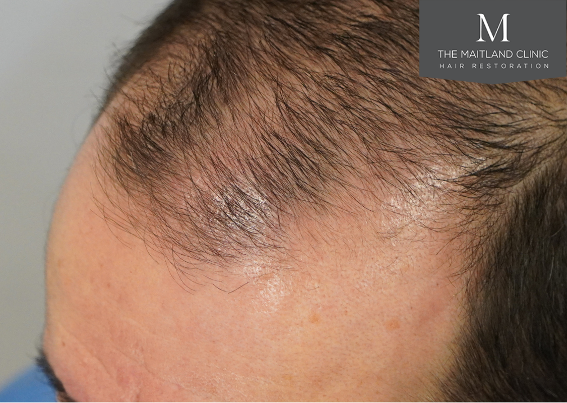 3803 grafts by FUT