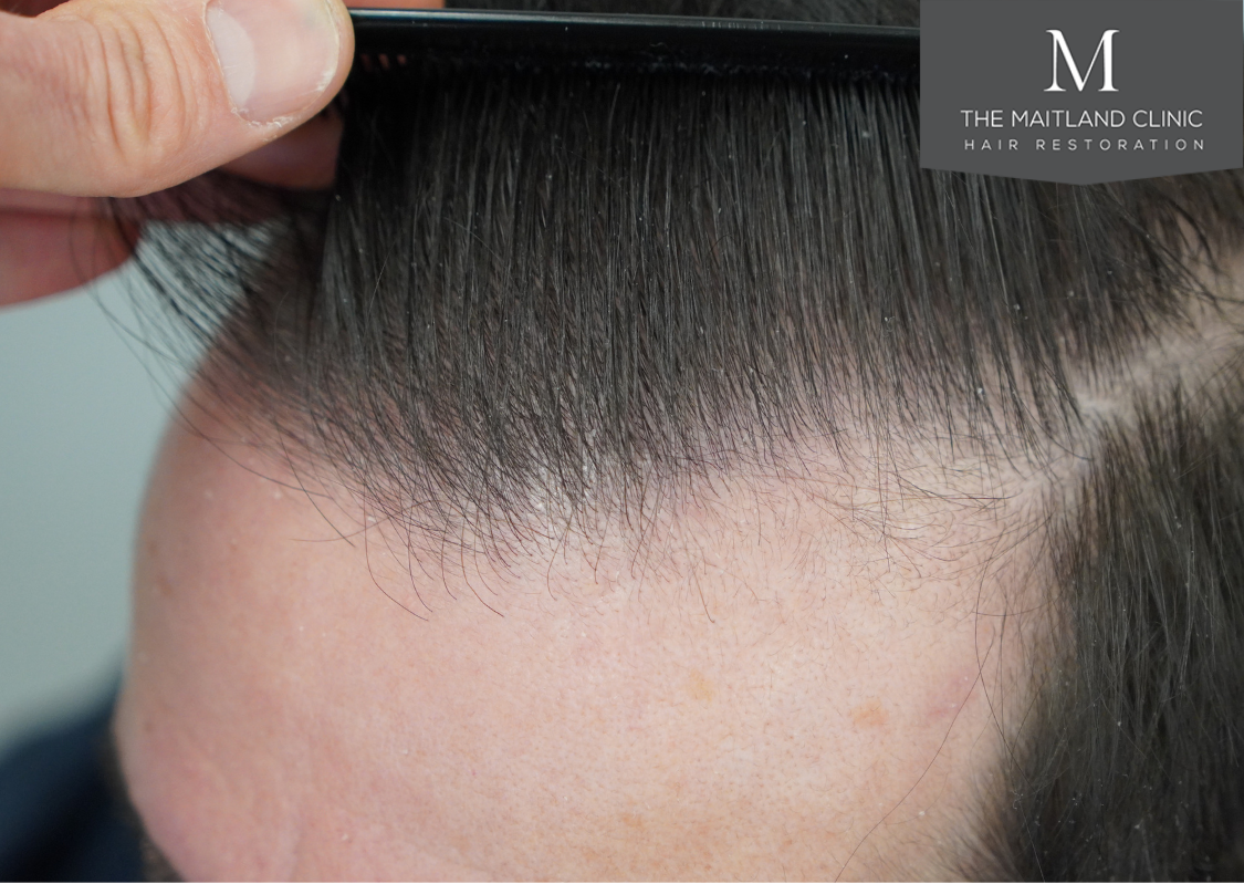 3803 grafts by FUT