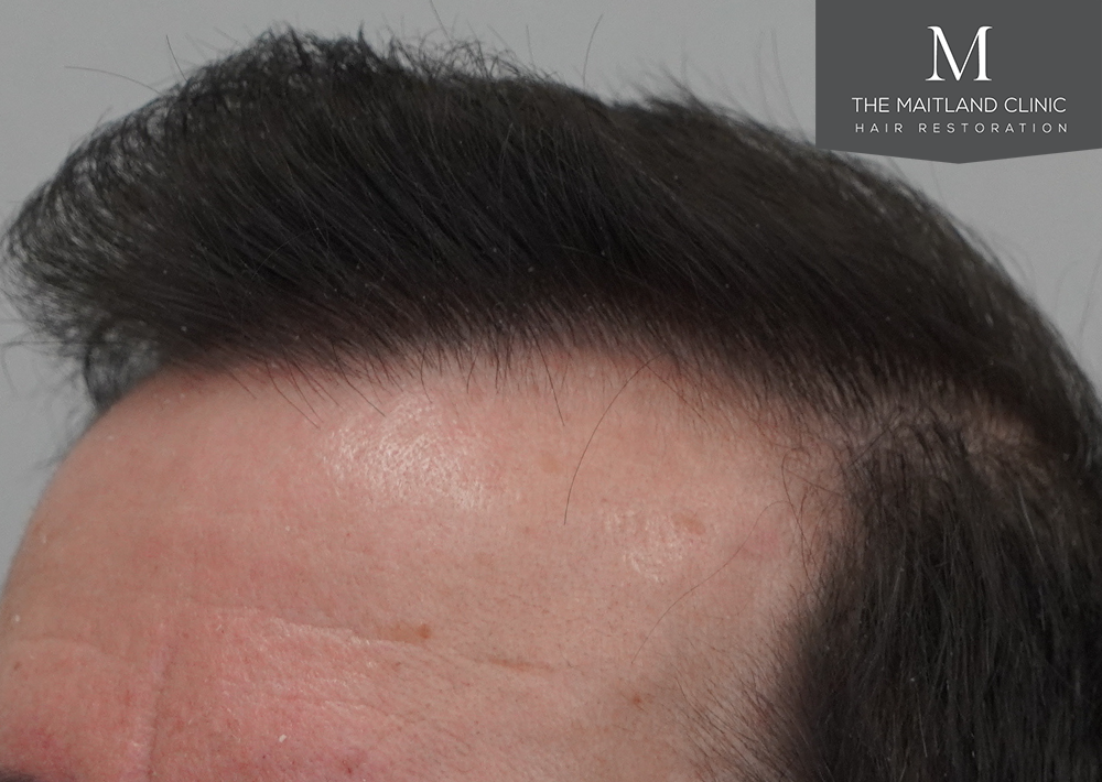 3803 grafts by FUT