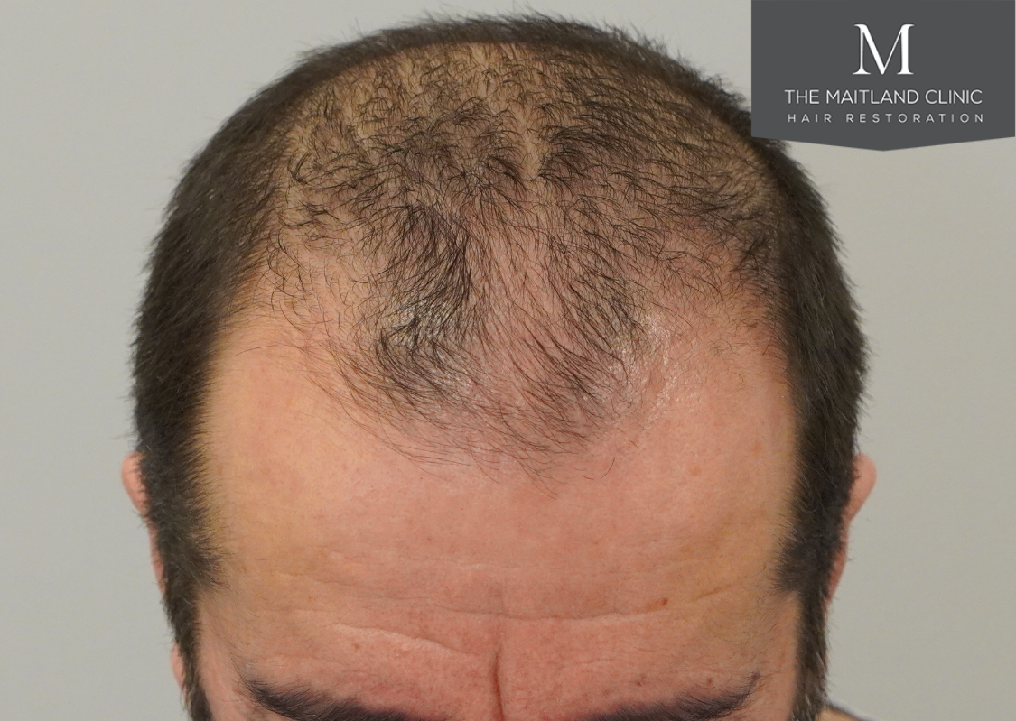 3803 grafts by FUT