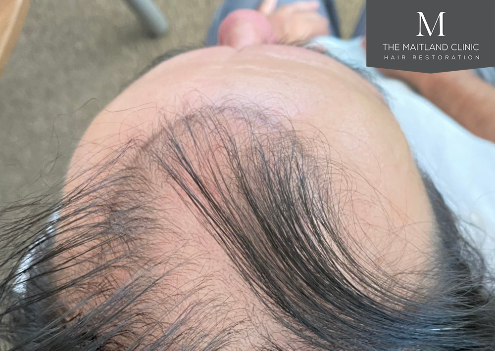 3803 grafts by FUT