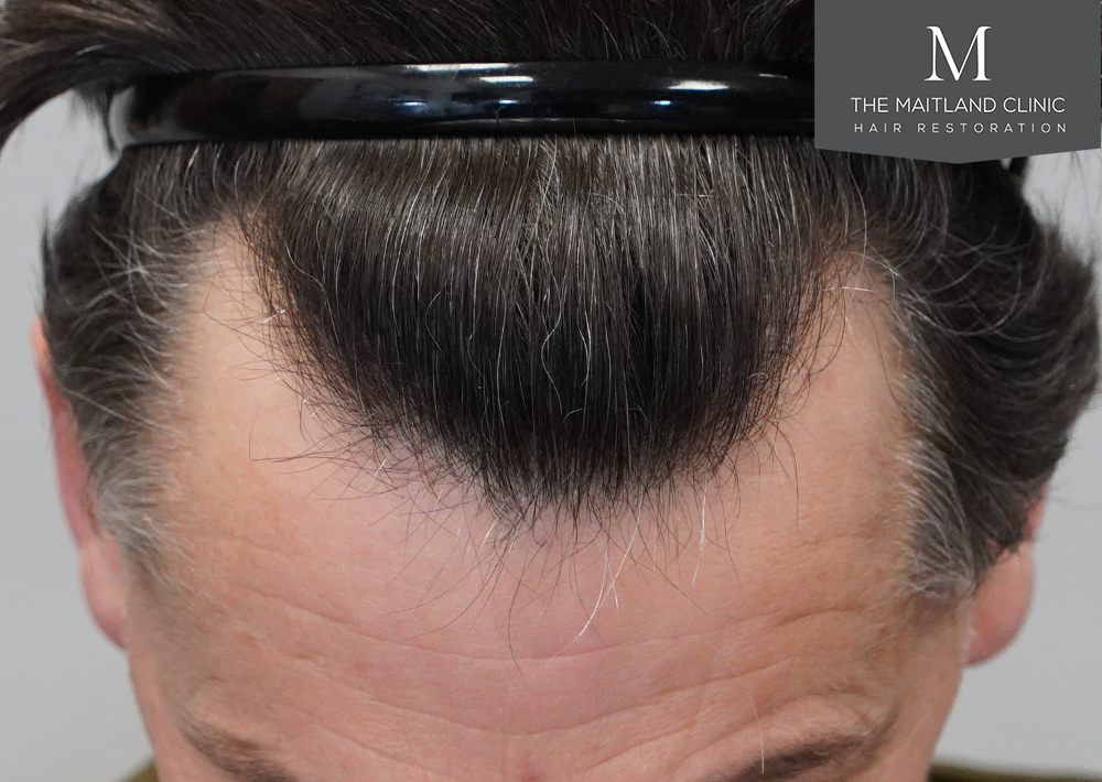 1357 grafts by FUE